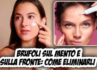 Brufoli su mento e fronte