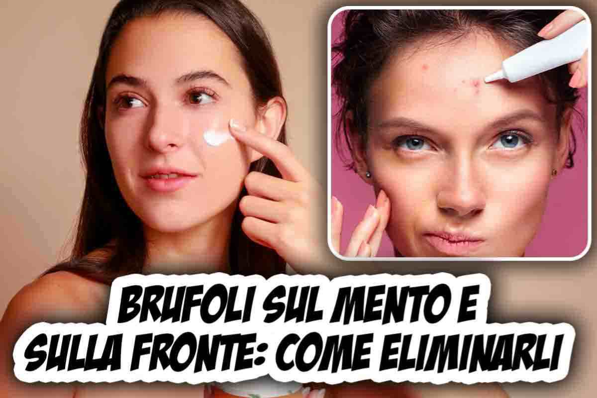 Brufoli su mento e fronte