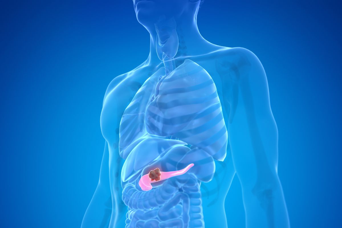 Cancro pancreas sintomi da non sottovalutare