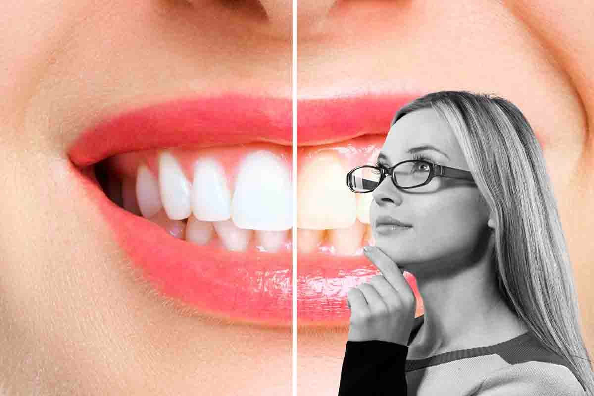 perché sbiancare i denti è pericoloso