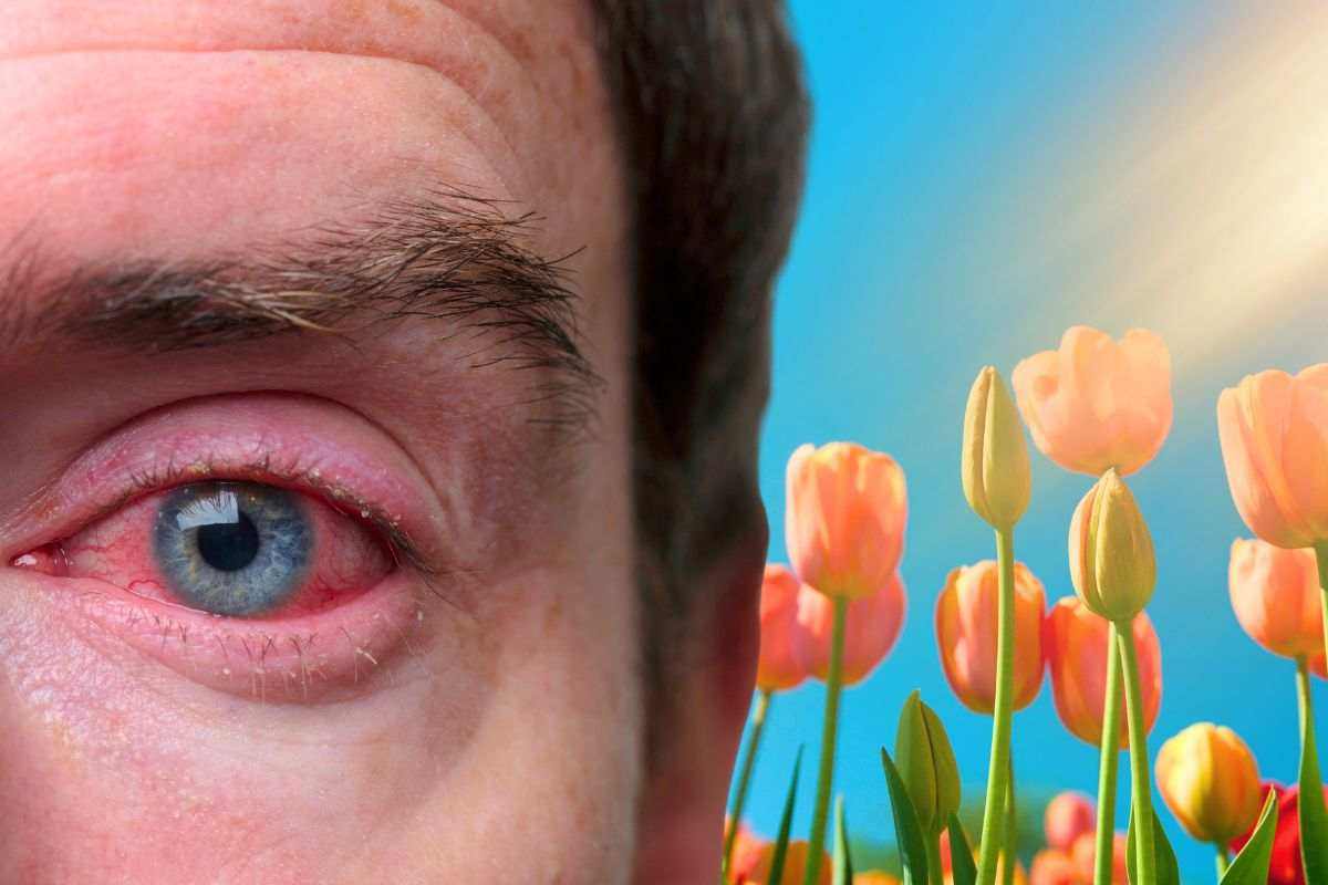 occhi rossi allergia primavera